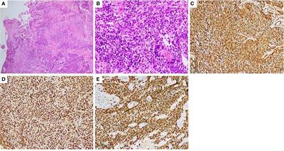 Case report: Metastatic refractory undifferentiated small round-cell sarcoma successfully treated with surufatinib and camrelizumab